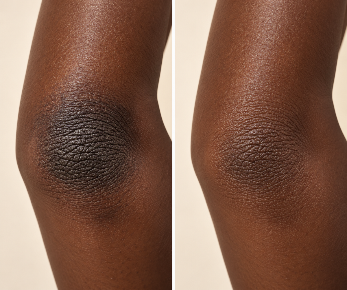 Avant et après d’un coude sur peau noire très foncée, hyperpigmentation marquée puis teint plus uniforme